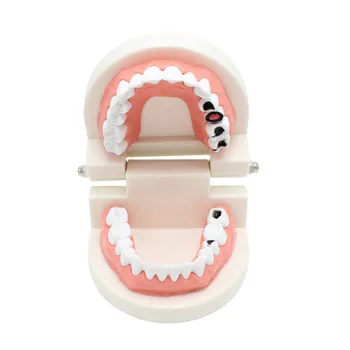 Стандартная ортодонтическая модель, модель для коррекции зубов, демонстрационная модель для обучения лечению кариеса